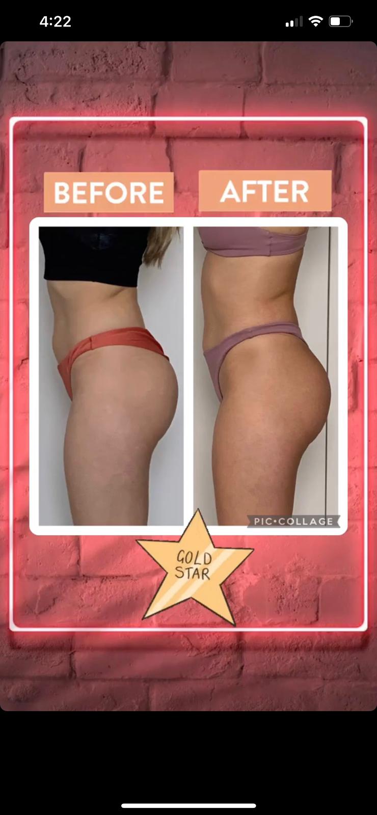 Resultado de aluna 1 — antes e depois do Intensivo Amnésia Glútea