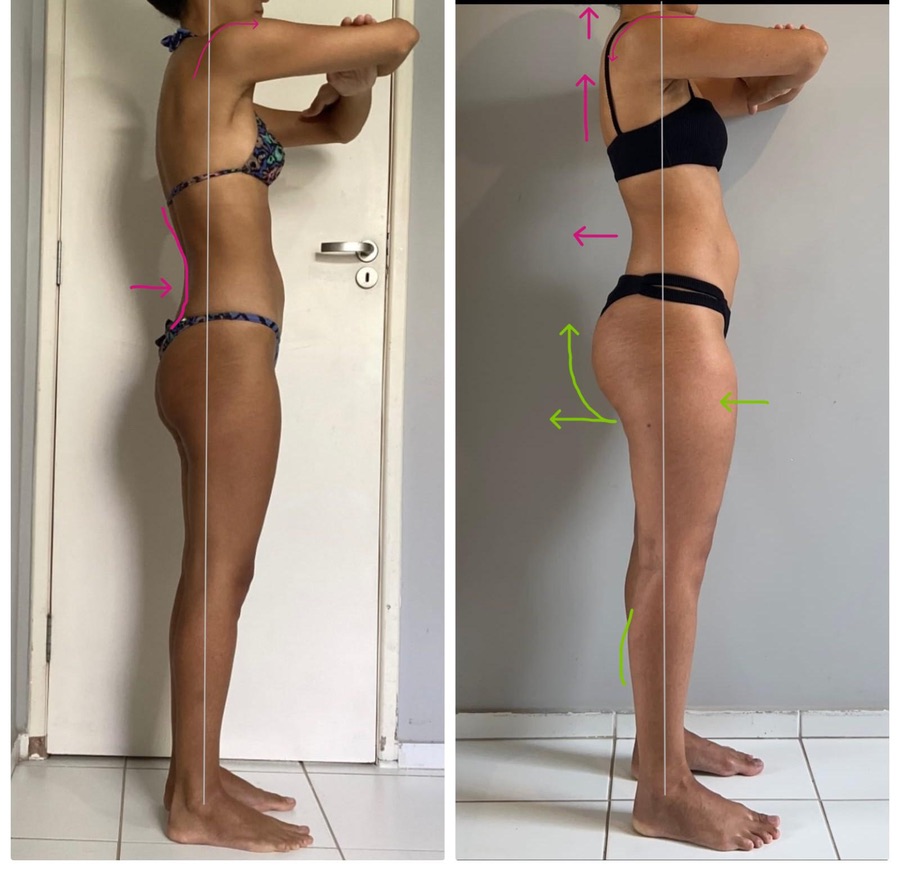 Resultado de aluna 2 — antes e depois do Intensivo Amnésia Glútea